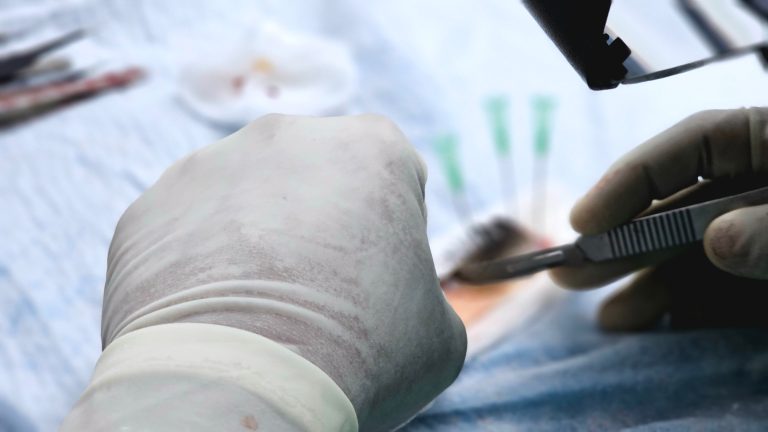 Machine Perfusion Aim Meets Organ Transplant System Gaps 1 Gloved hands hold instruments during surgery